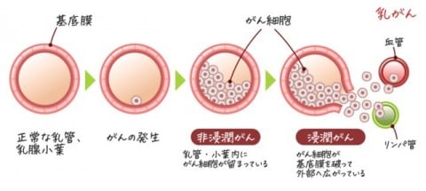 乳がんの発生