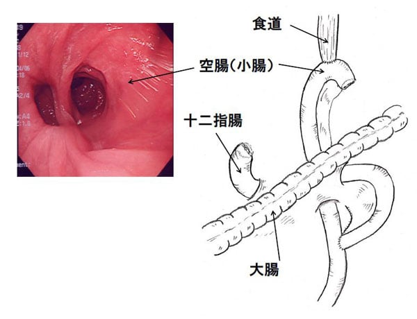 代用胃について｜佐久市立国保浅間総合病院（佐久市病院事業）公式サイト